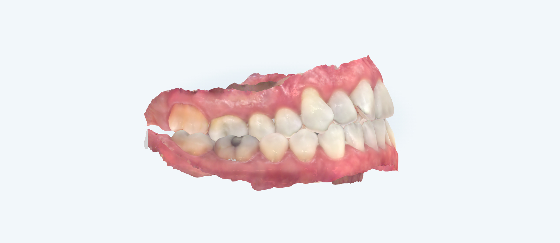 Crossbite treatment comparison case 2 before